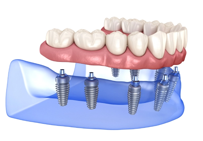 All-on-X Dental Implants in Temple, TX