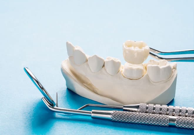 Dental Bridges in Temple, TX