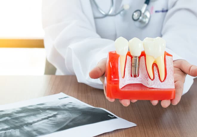 Dental Implants in Temple, TX
