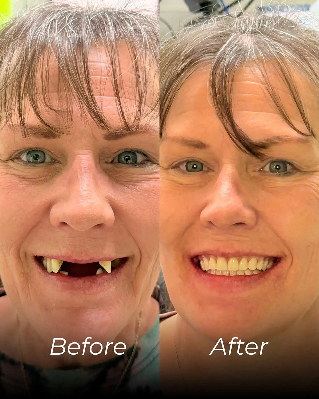 All-on-X Dental Implants in Temple, TX