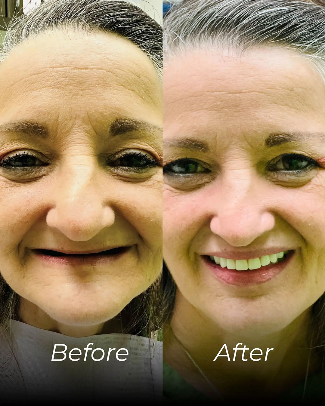 All-on-X Dental Implants in Temple, TX