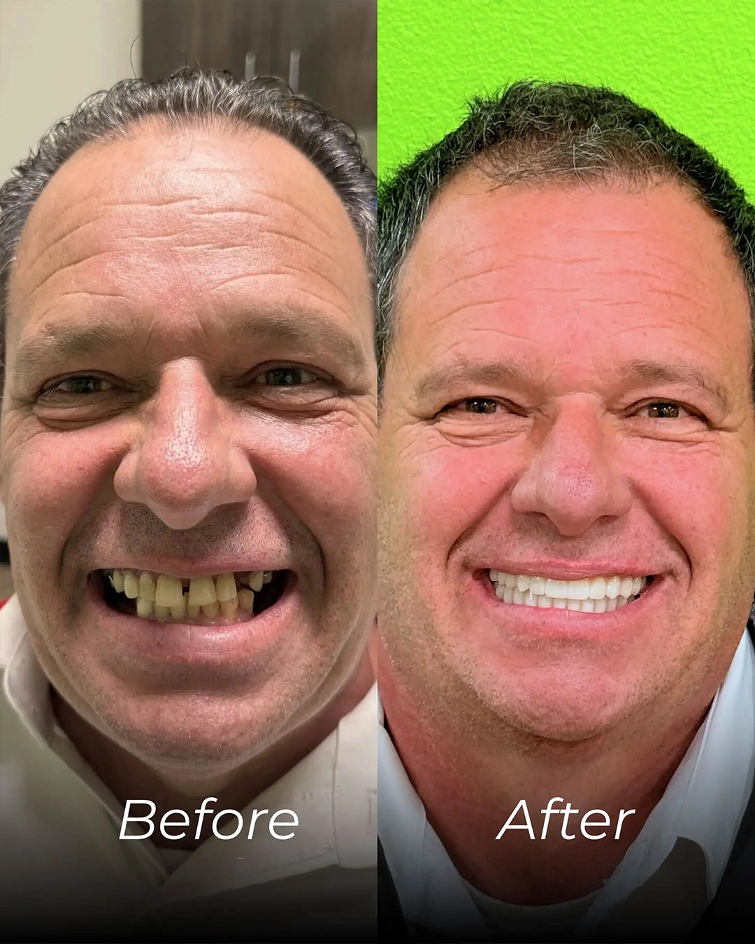 All-on-X Dental Implants in Temple, TX