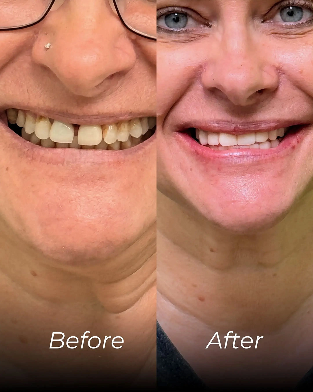 All-on-X Dental Implants in Temple, TX