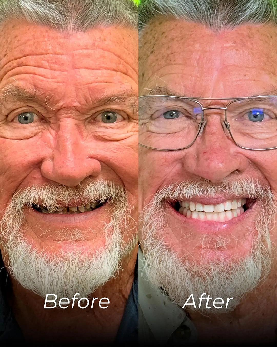 All-on-X Dental Implants in Temple, TX
