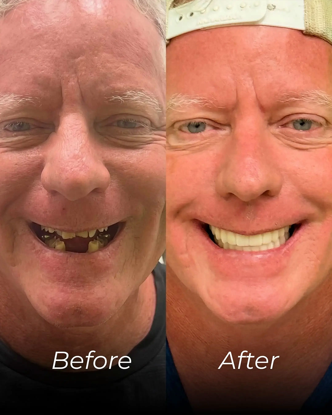 All-on-X Dental Implants in Temple, TX