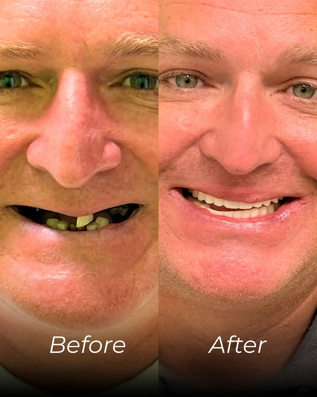 All-on-X Dental Implants in Temple, TX