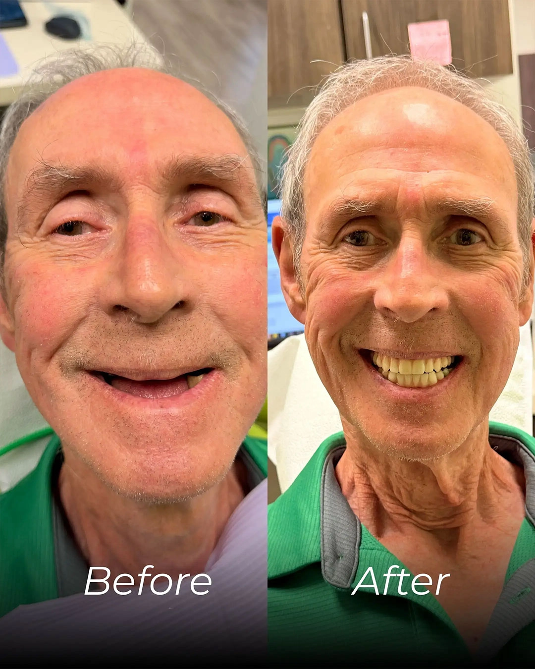 All-on-X Dental Implants in Temple, TX