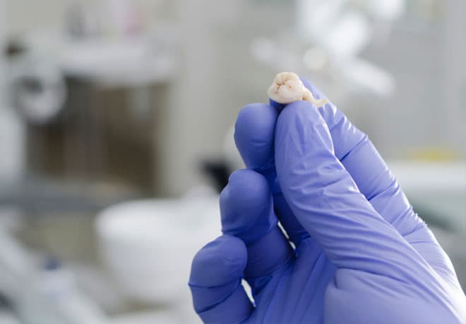 Tooth Extractions in Temple, TX